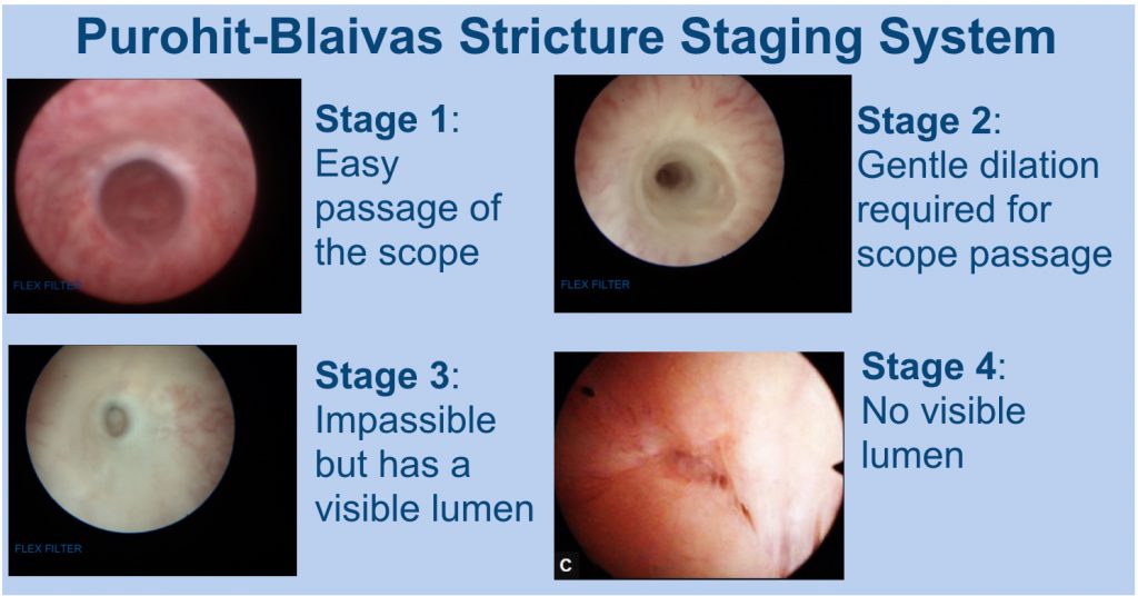 Urethral Stricture Staging System