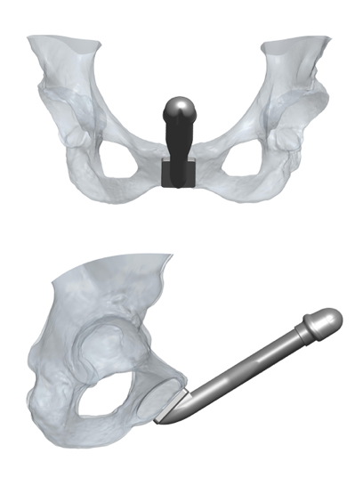 Custom penile prosthesis for transmen
