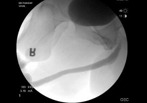 Urethral Stricture Post Op Pics 02