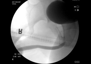 Urethral Stricture Post Op Pics 03