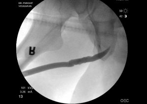 Urethral Stricture Post Op Pics 04