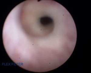Urethral Stricture Pre Op Cystoscopy Pics 03