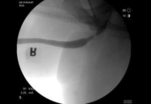 Urethral Stricture Before Pics 02