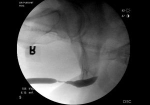 Urethral Stricture Before Pics 04