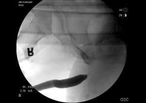 Urethral Stricture Before Pics 05