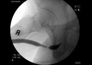 Urethral Stricture Before Pics 06