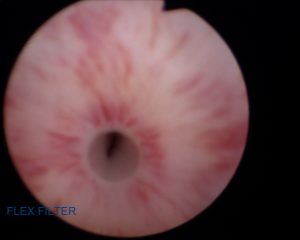 Urethral Stricture Pre Op Cystoscopy Pics 06